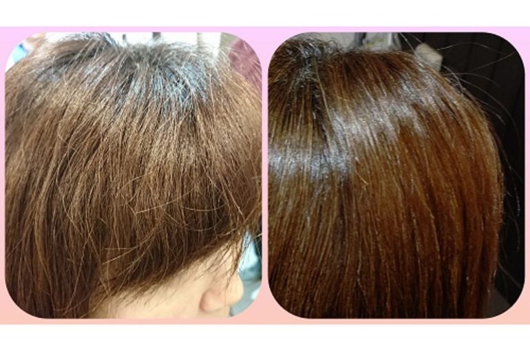 酸熱トリートメント